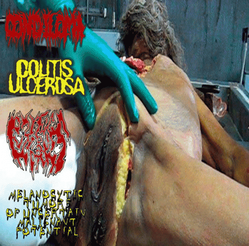 Melanocytic Tumors Of Uncertain Malignant Potential : Condiloma - Colitis Ulcerosa - Oxytocin Uterus Worms - Melanocytic Tumors of Uncertain Malignant Pot Melanocytic Tumors Of Uncertain Malignant Potential : Condiloma - Colitis Ulcerosa - Oxytocin Uterus Worms - Melanocytic Tumors of Uncertain Malignant Pot